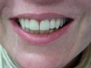 After veneers